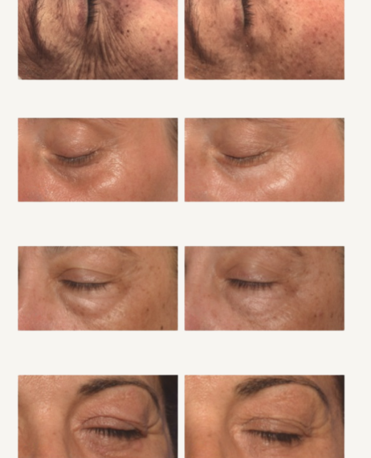Maison Beauty Lounge_Mesoesthetic_Eycos Augenbehandlung